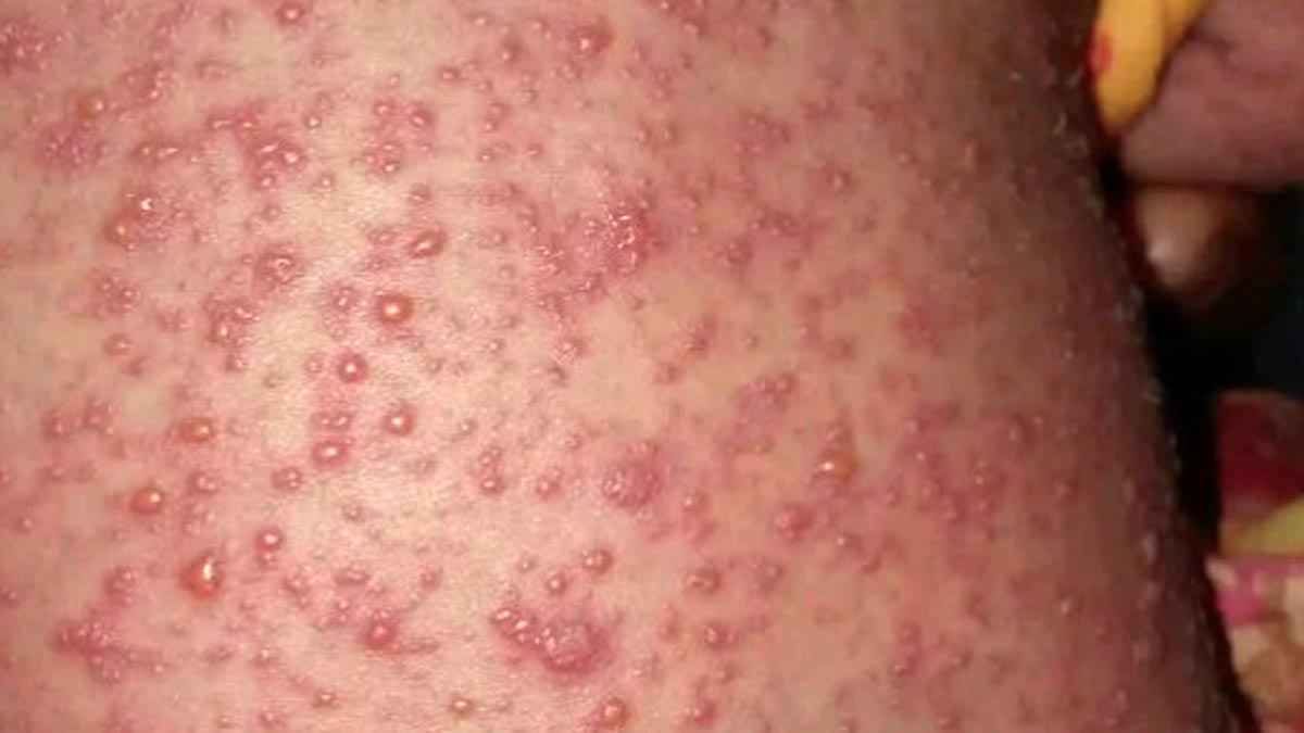 নীলফামারীতে হামের উপসর্গ নিয়ে নবজাতকের মৃত্যু