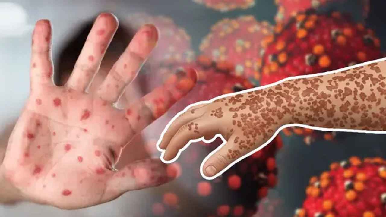 ২৪ ঘণ্টায় হাম ও হামের উপসর্গে ৮ জনের মৃত্যু