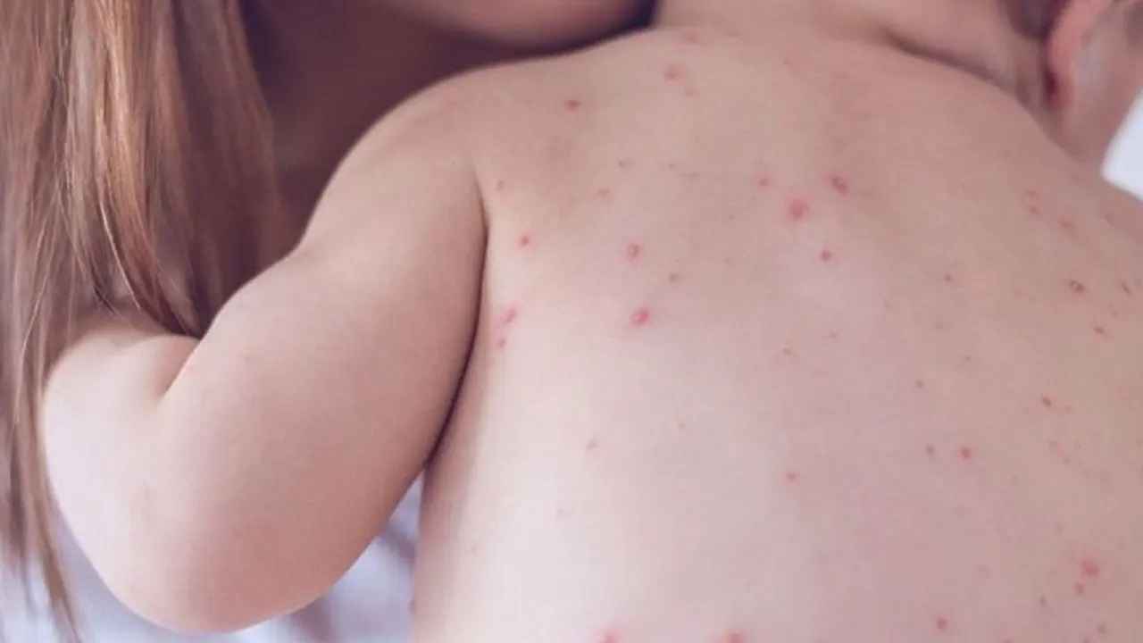 হাম ও উপসর্গে আরও ৭ শিশুর মৃত্যু