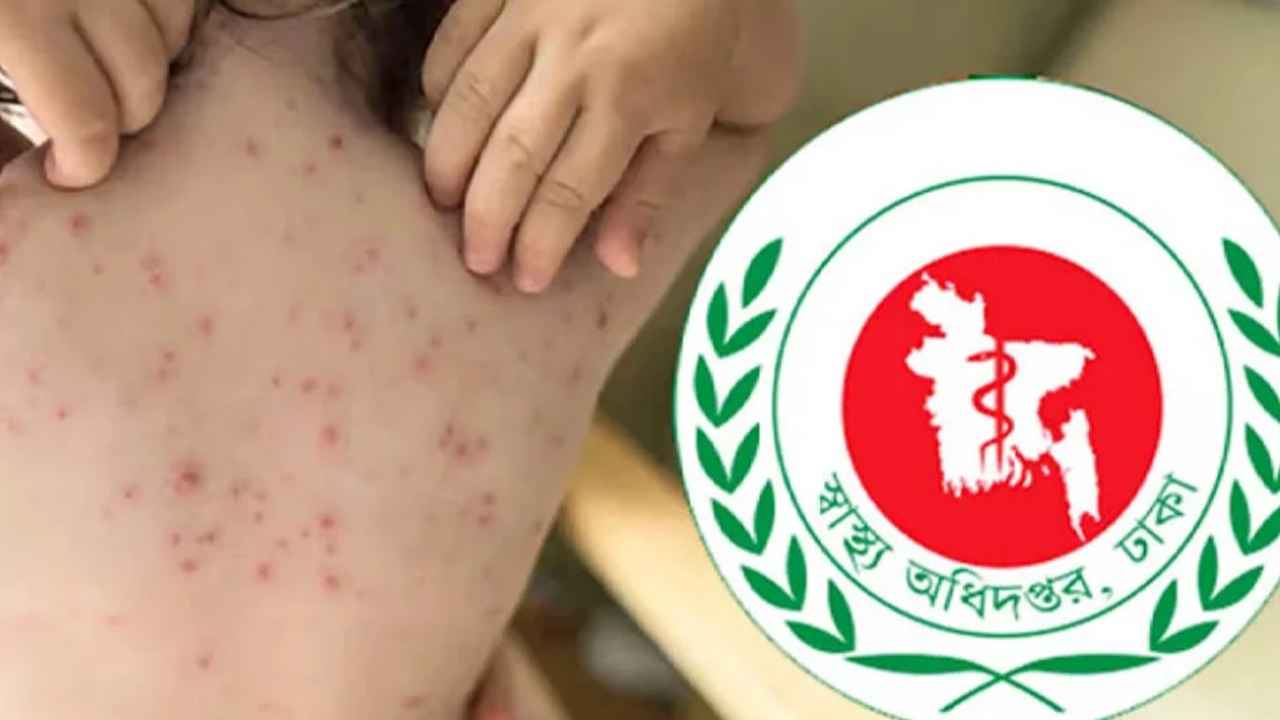 হামের উপসর্গ নিয়ে আরও ৪ শিশুর মৃত্যু