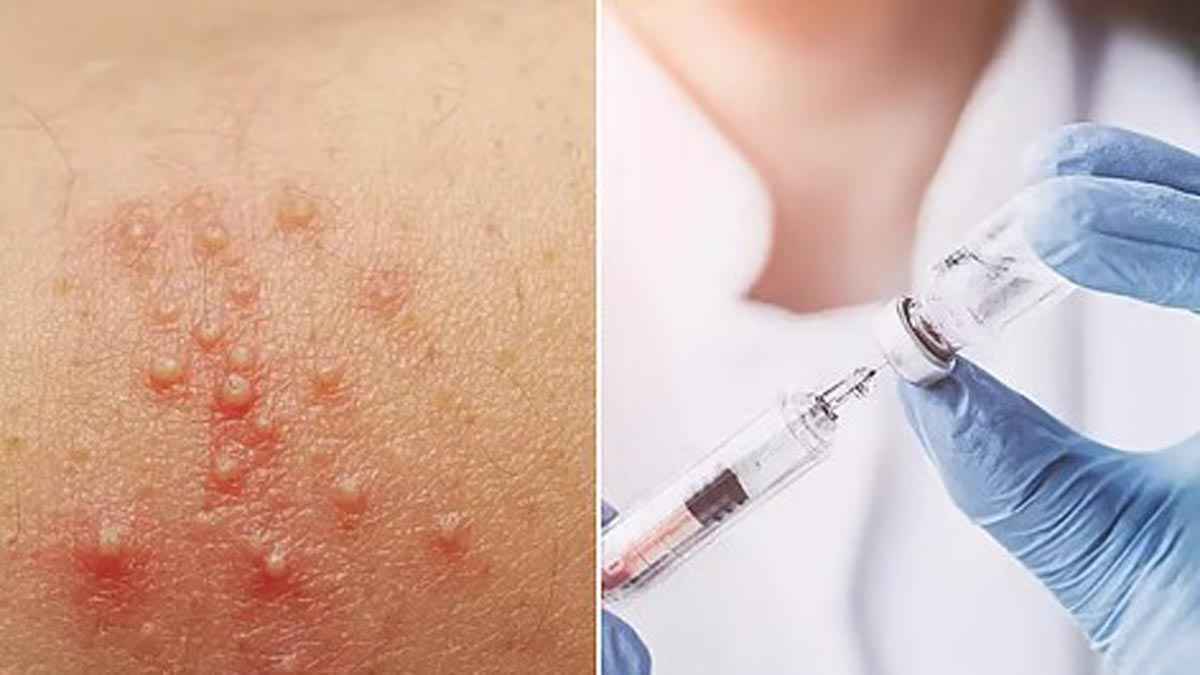 লক্ষ্মীপুরে পৌনে তিন লাখ শিশুকে দেওয়া হবে হামের টিকা