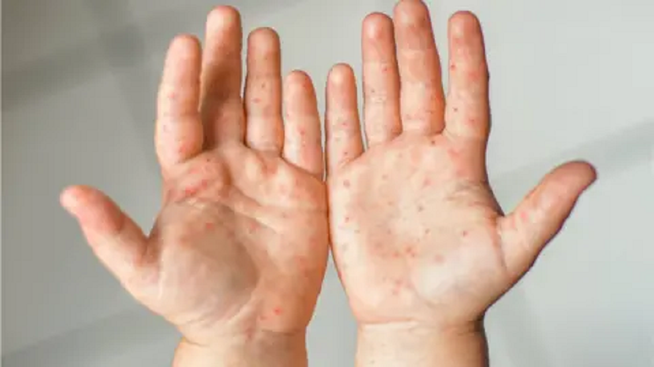 হাম ও উপসর্গে মৃত্যু আরও ৪