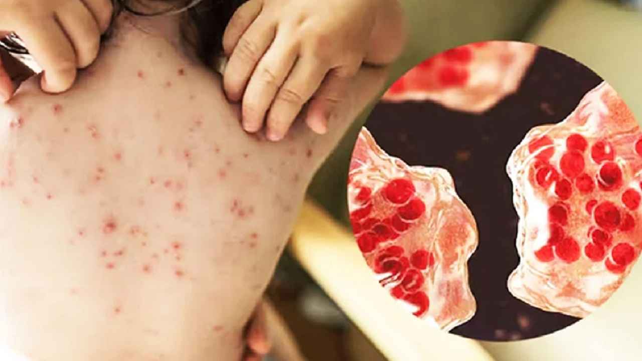 হাম ও উপসর্গে আরও ৫ শিশুর মৃত্যু, আক্রান্ত ২৮ হাজার ছাড়িয়েছে