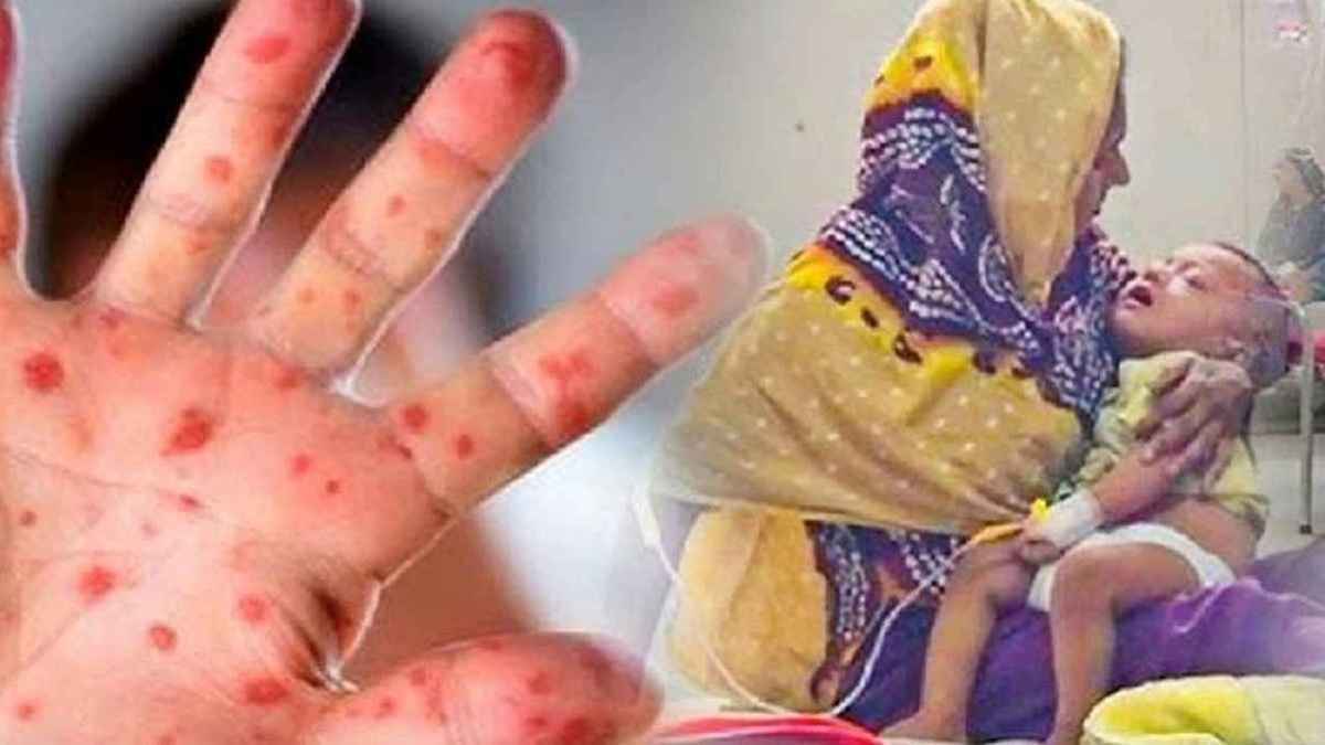 হামের টিকা পেয়েছে ৯৪ লাখ ২৪ হাজার শিশু: প্রধানমন্ত্রীর তথ্য উপদেষ্টা