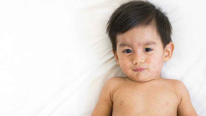 হাম হলে কি গোসল করা যায়?