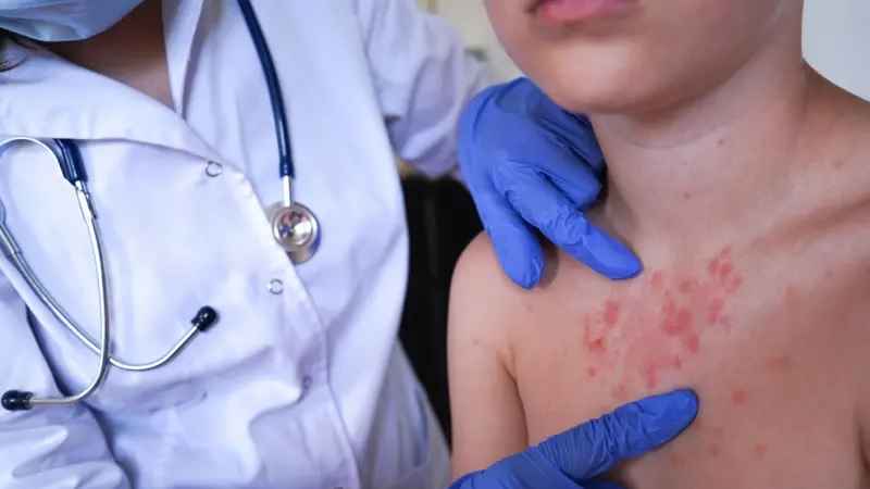 ২৪ ঘণ্টায় হামের লক্ষণ নিয়ে চারজনের মৃত্যু