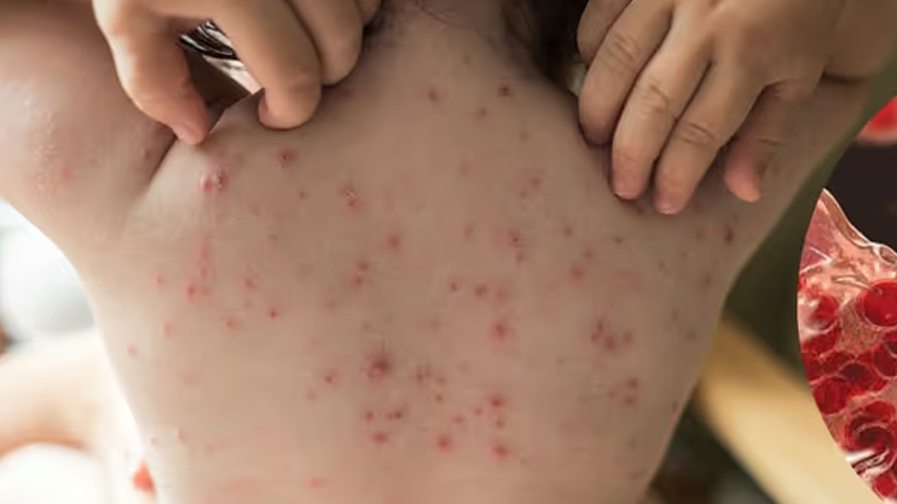 টিকা নেওয়ার পরও কী হাম হতে পারে?