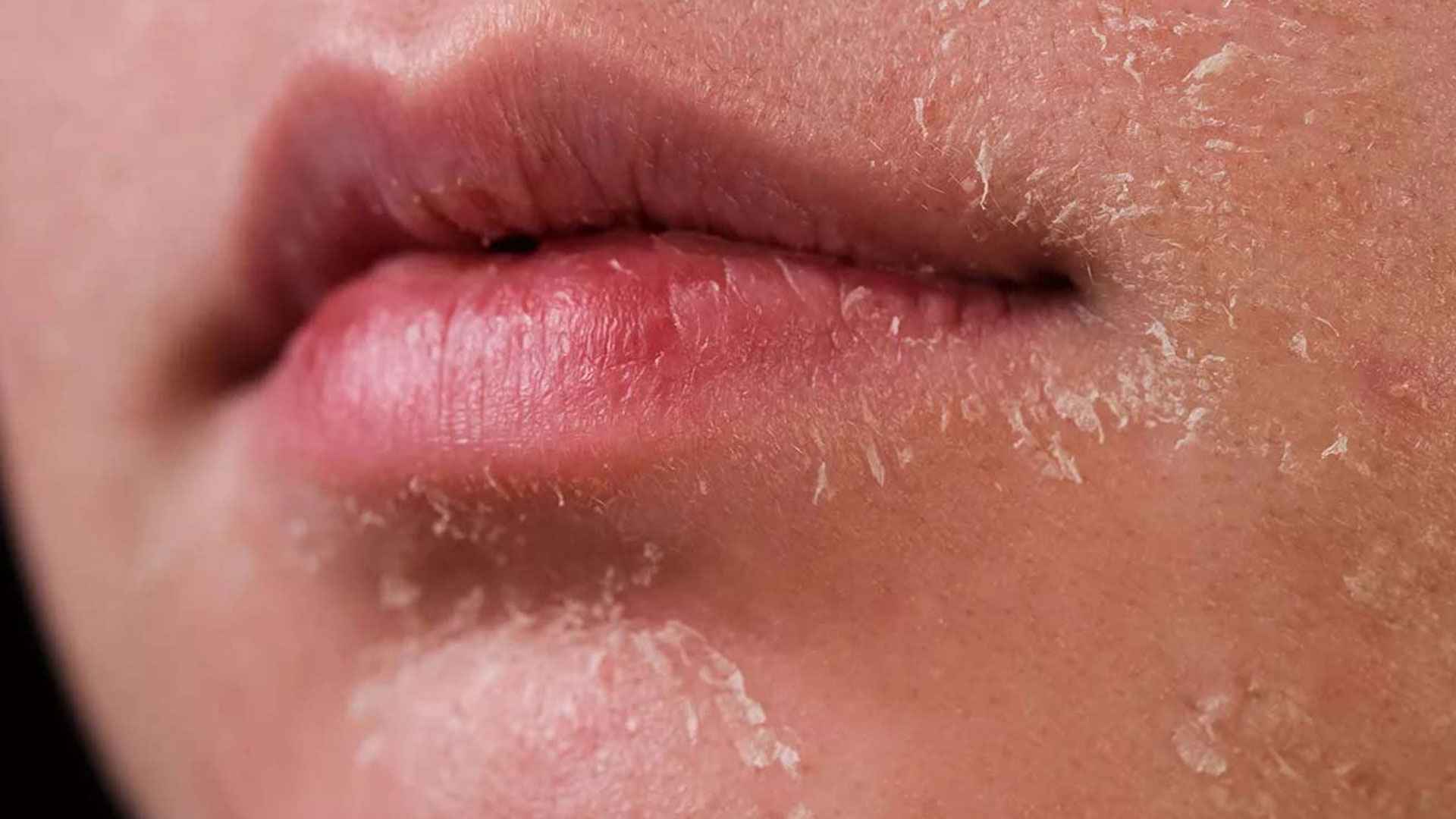 ত্বকের এই সাধারণ সমস্যাগুলোই হতে পারে কিডনি খারাপের ইঙ্গিত