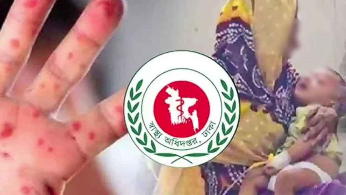 হামের উপসর্গে আরও ৩ শিশুর মৃত্যু