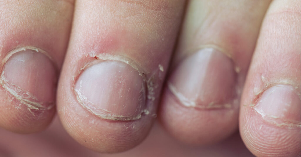 bitten-fingernails-1024x536 bitten-fingernails-1024x536