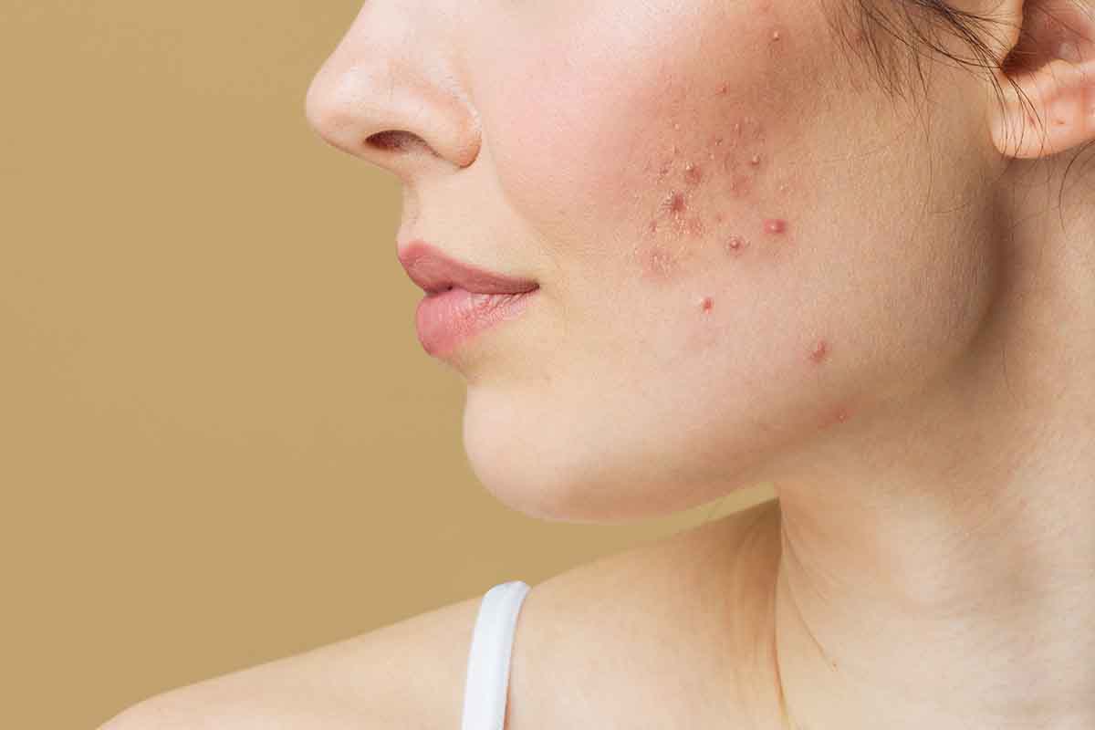 acne_1