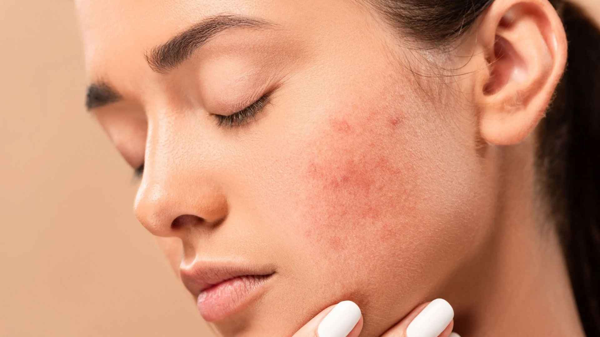 বার বার ফিরে আসে ব্রণ, কেন এমন হয়?
