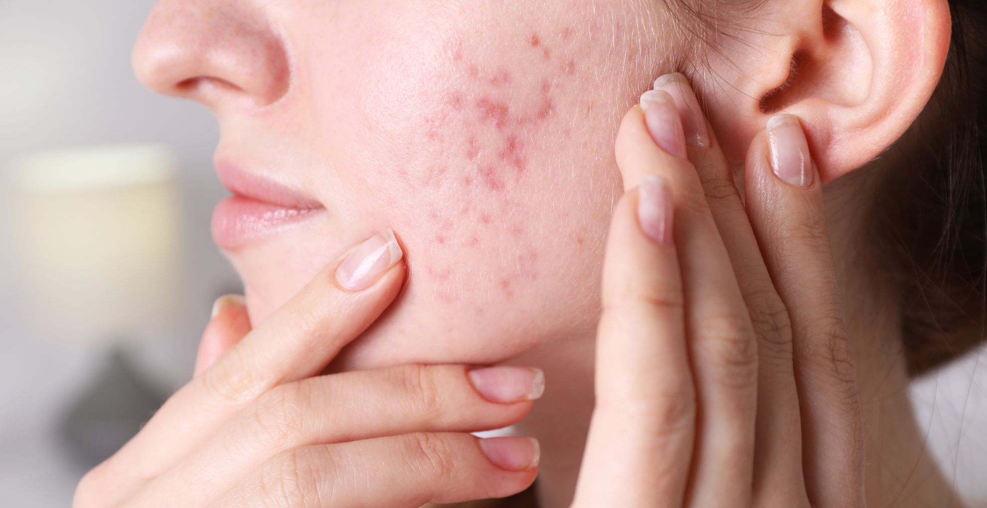 hormonal-acne
