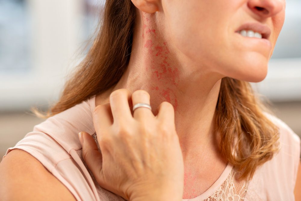 allergy-skin-rash allergy-skin-rash
