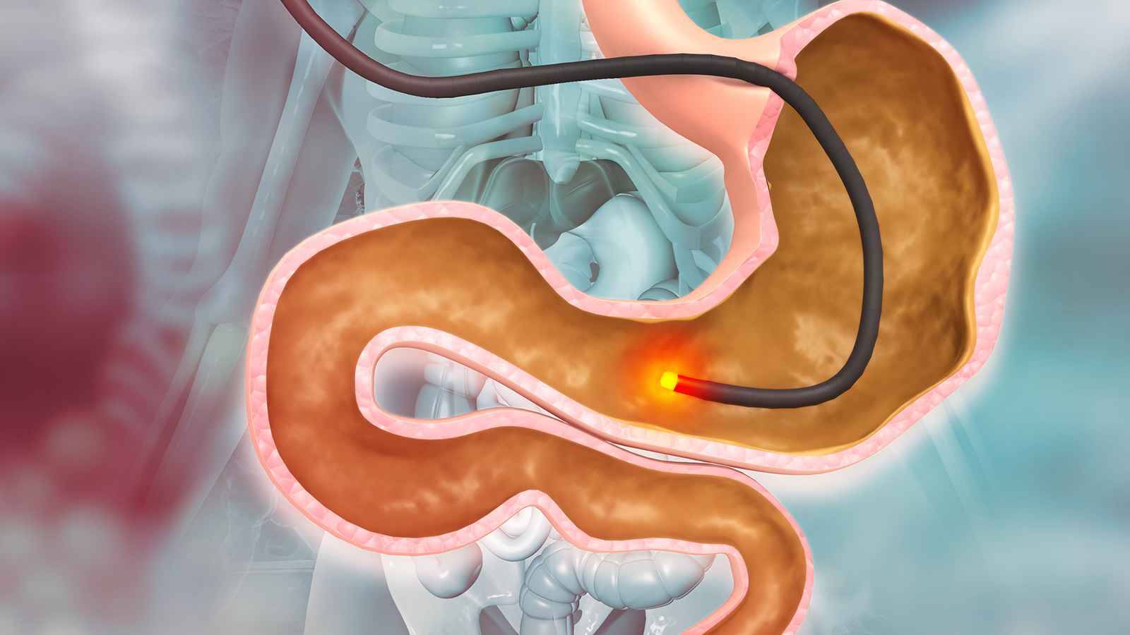 এন্ডোস্কপিতে সফলভাবে অপসারণ হলো বিরল ডুওডেনাল টিউমার