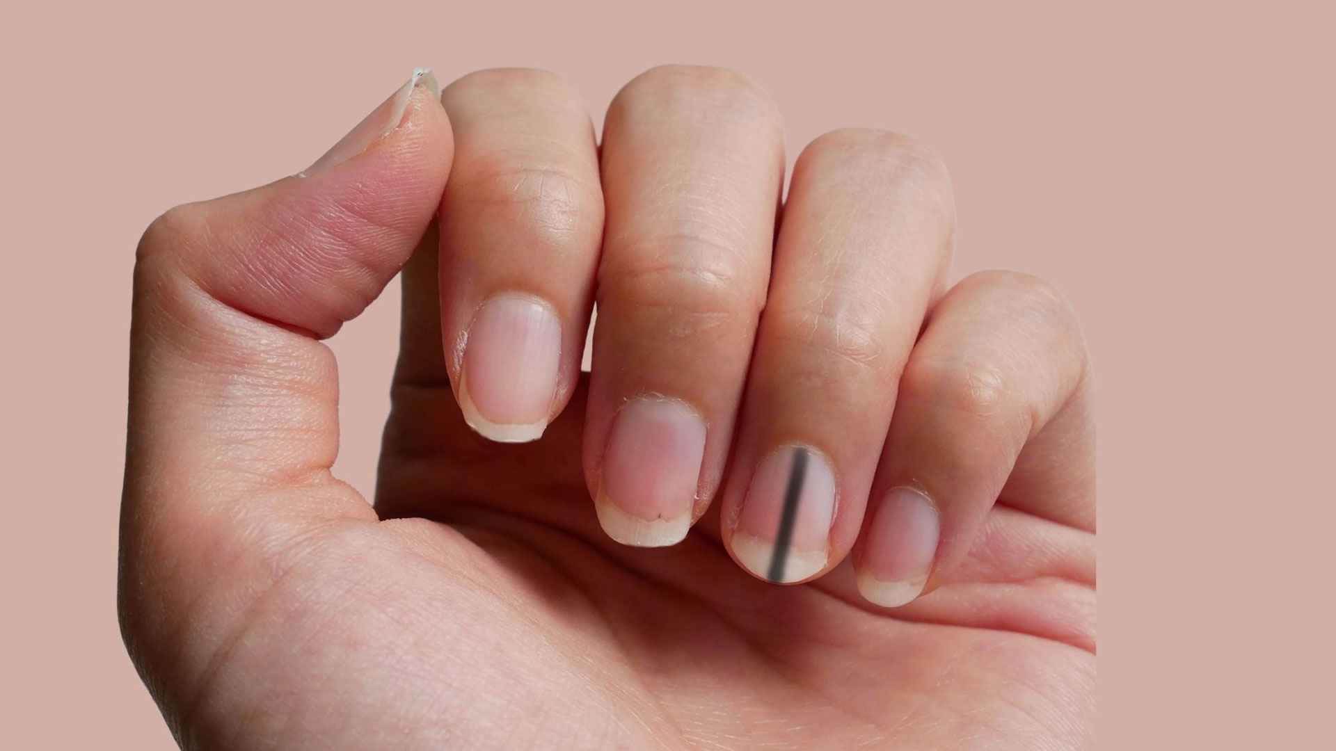 নখের নিচে লম্বা কালো দাগ কি ক্যানসারের লক্ষণ? 