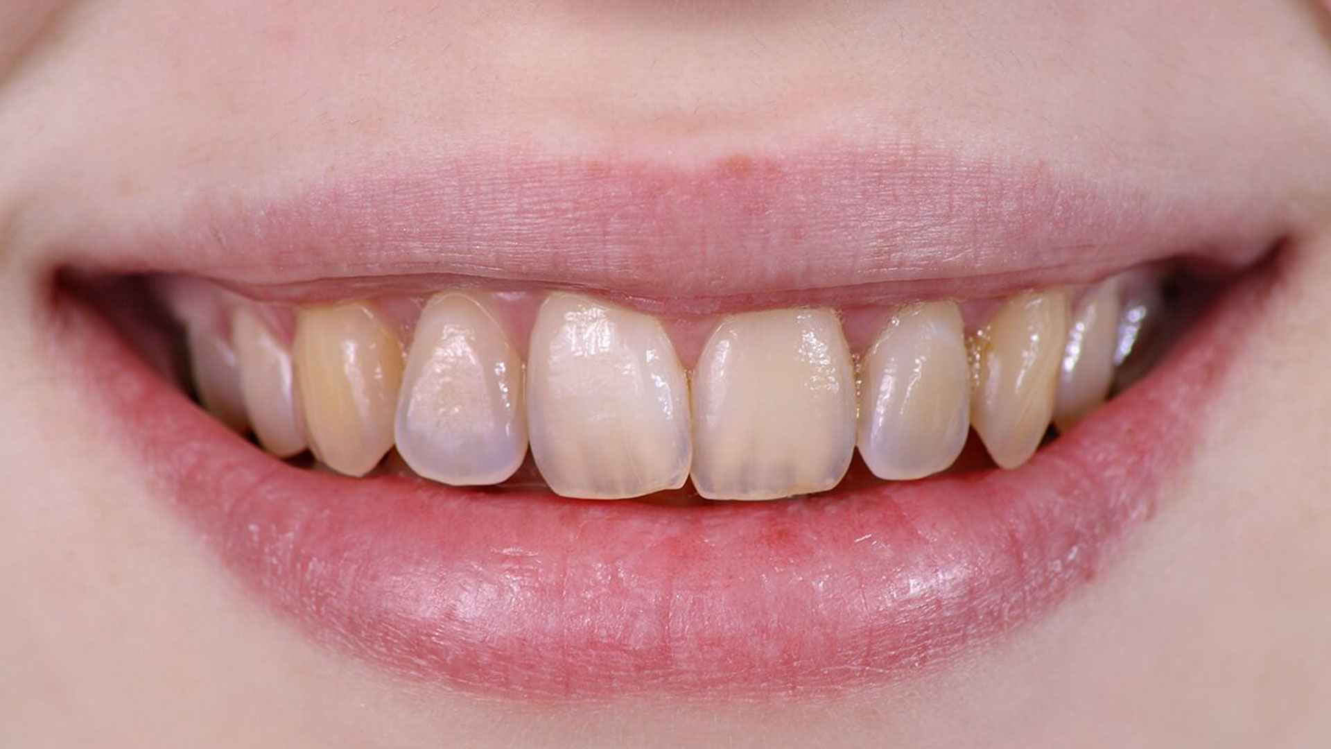 দাঁতের এনামেল নষ্ট হয় এসব খাবার খেলে 