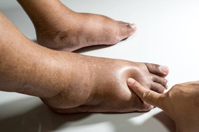 edema edema