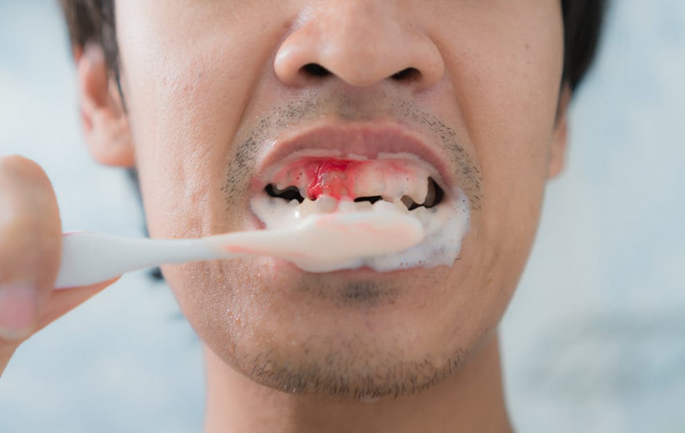 Bleeding-gums-from-brushing-teeth