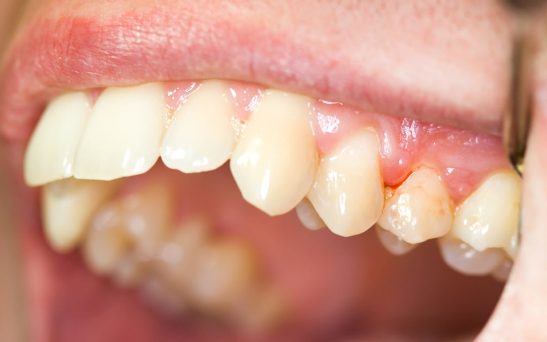 bleeding-gums-1