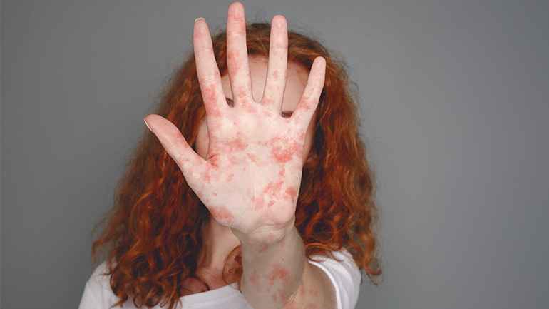 হাম কি ছোঁয়াচে রোগ?