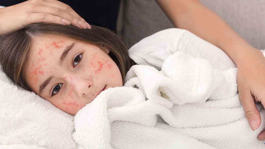 শিশুদের পাশাপাশি বড়দেরও কি হাম হতে পারে?