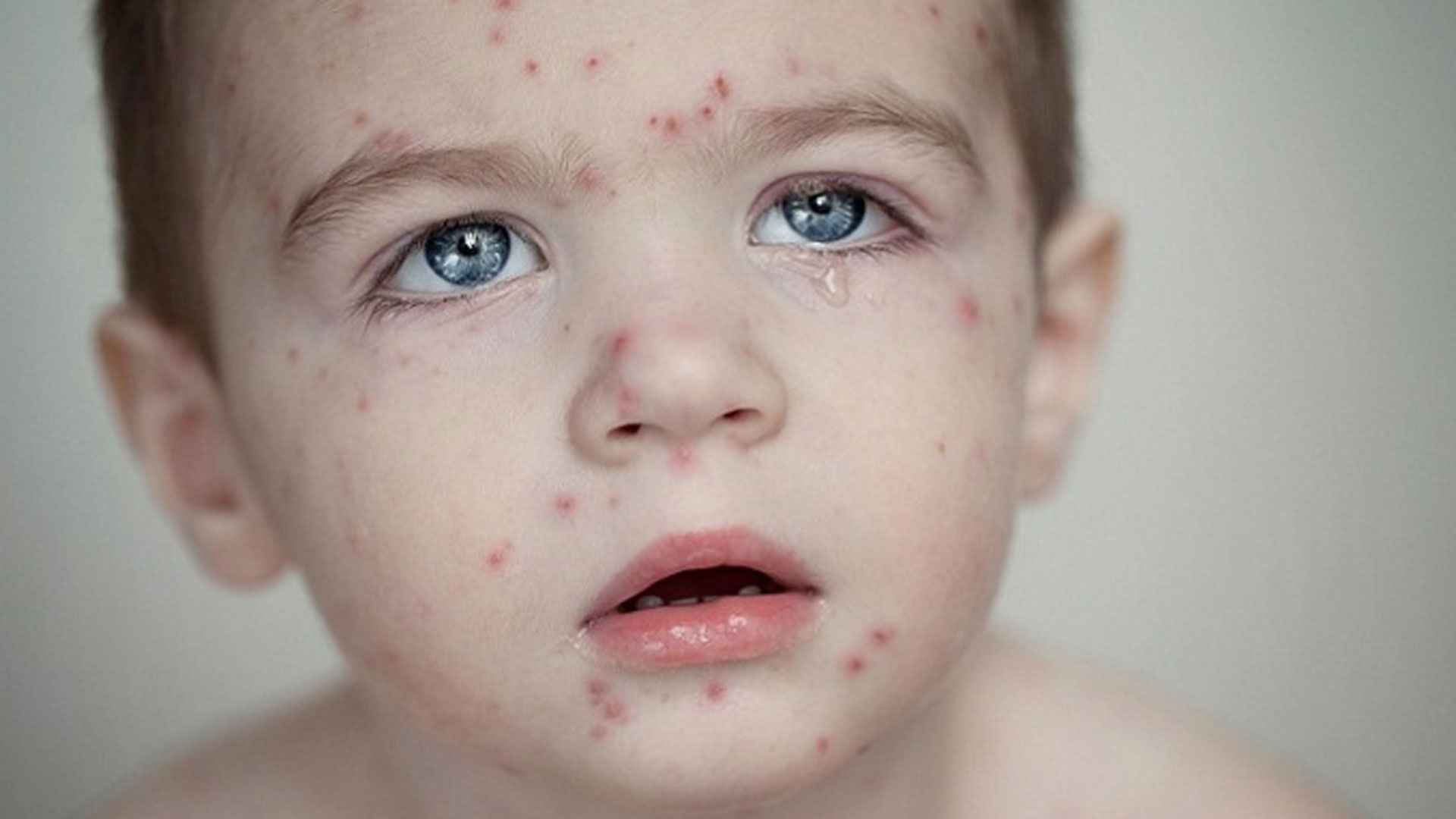 চোখ রাঙাচ্ছে হাম, যা জানা জরুরি!