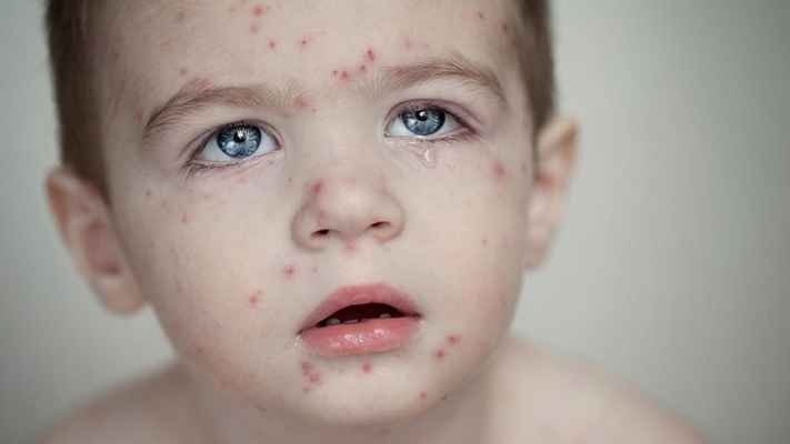 হাম কি প্রাণঘাতী রোগ?