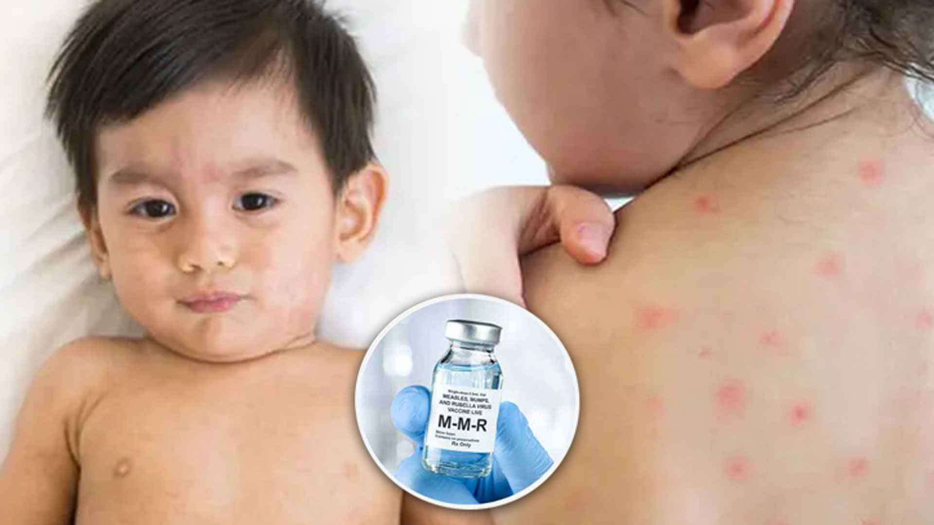 বাংলাদেশ ছাড়াও যেসব দেশের মানুষ হামে আক্রান্ত হচ্ছে 