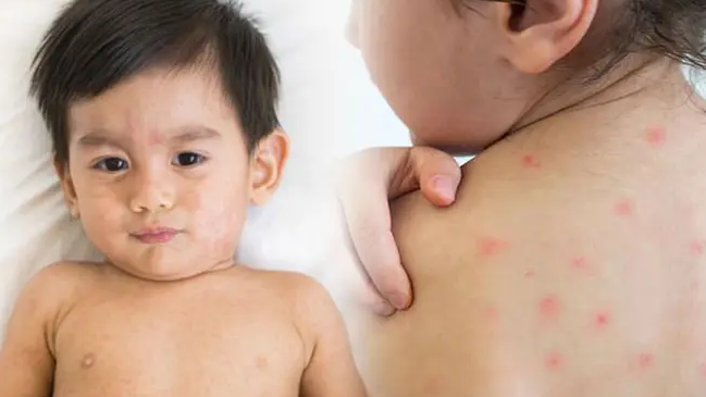 এসব লক্ষণ দেখলেই বুঝবেন আপনার শিশু হামে আক্রান্ত