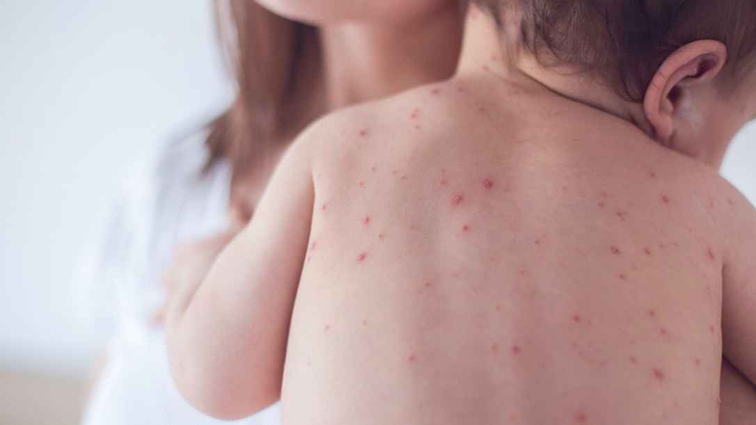 হাম রোগের প্রতিকার ও প্রতিরোধ কী?