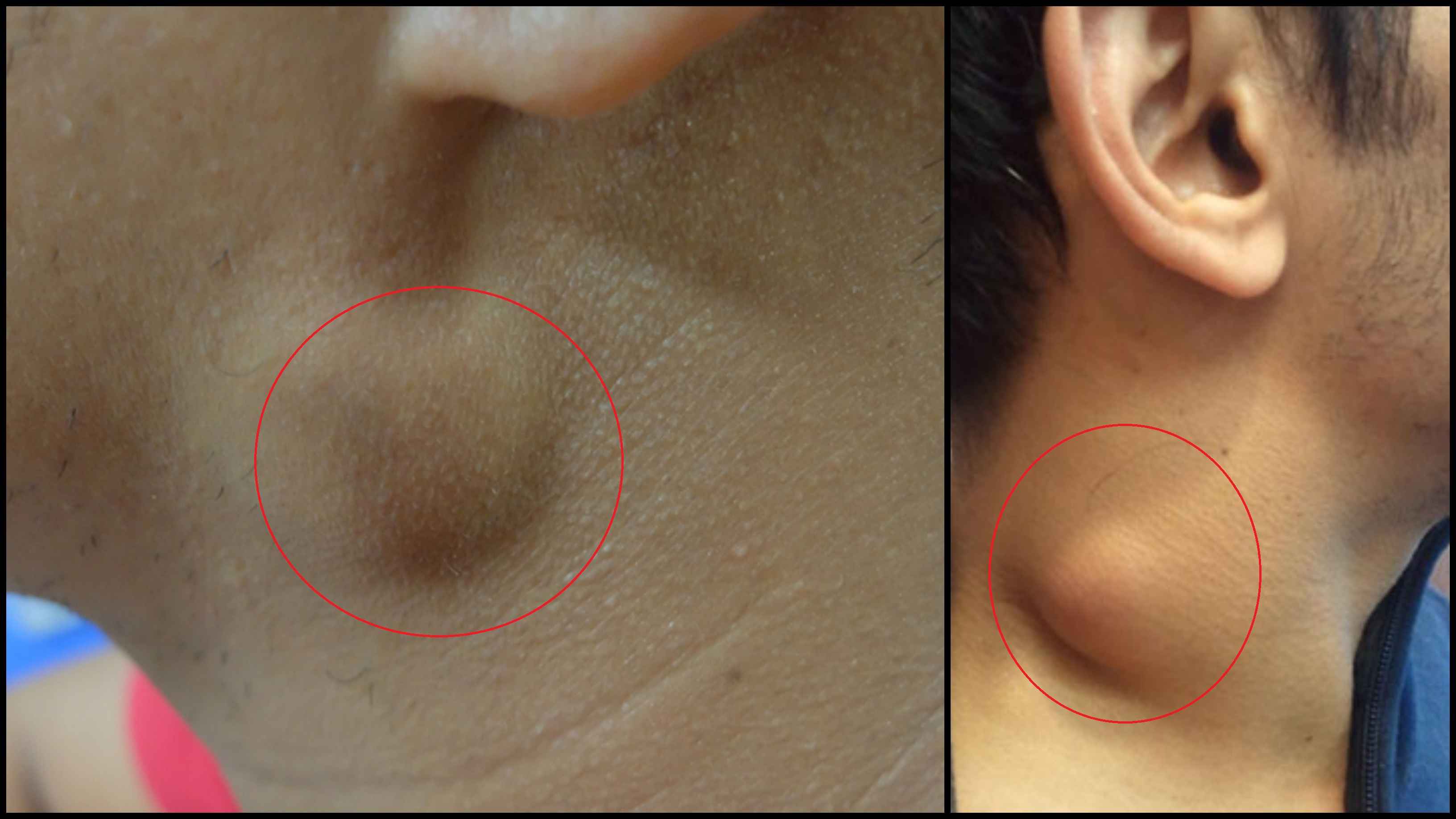 গলার কাছে হঠাৎ ফোলা মাংসপিণ্ড, বিপজ্জনক নয় তো?