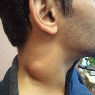 neck_lump neck_lump