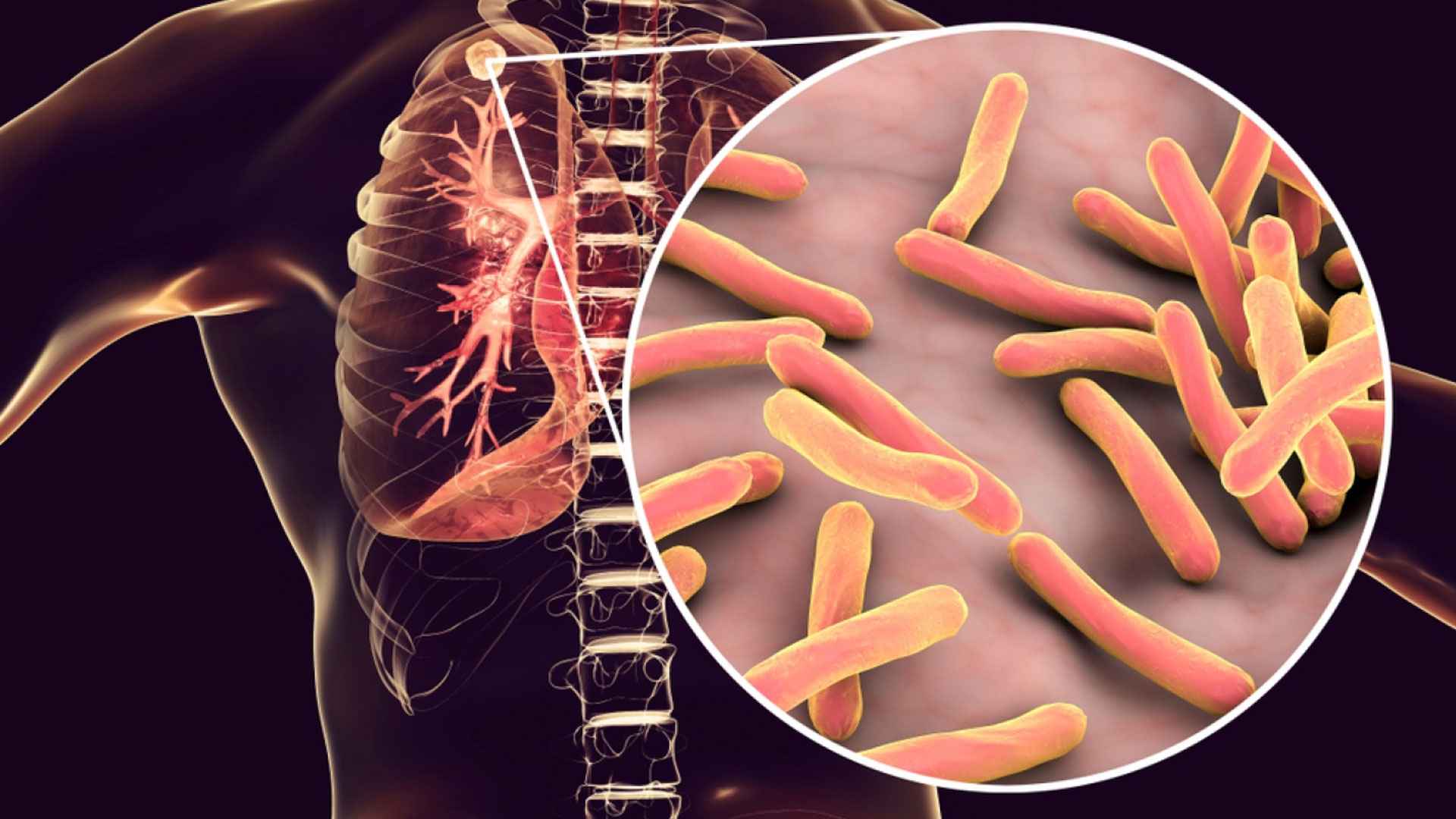 অপুষ্টির কারণেও হতে পারে যক্ষ্মা, টিবি থেকে বাঁচতে কেমন খাবার খাবেন?