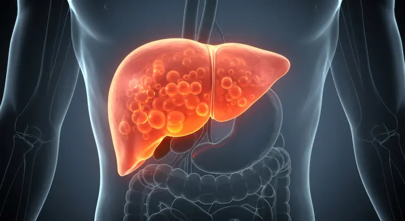 Fatty_Liver