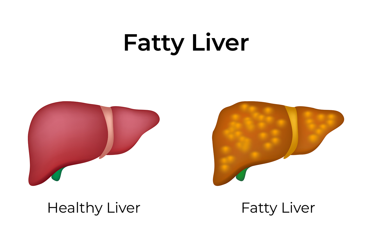 Treatment_for_Fatty_Liver_Disease