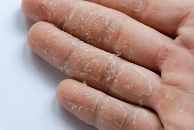 fungal