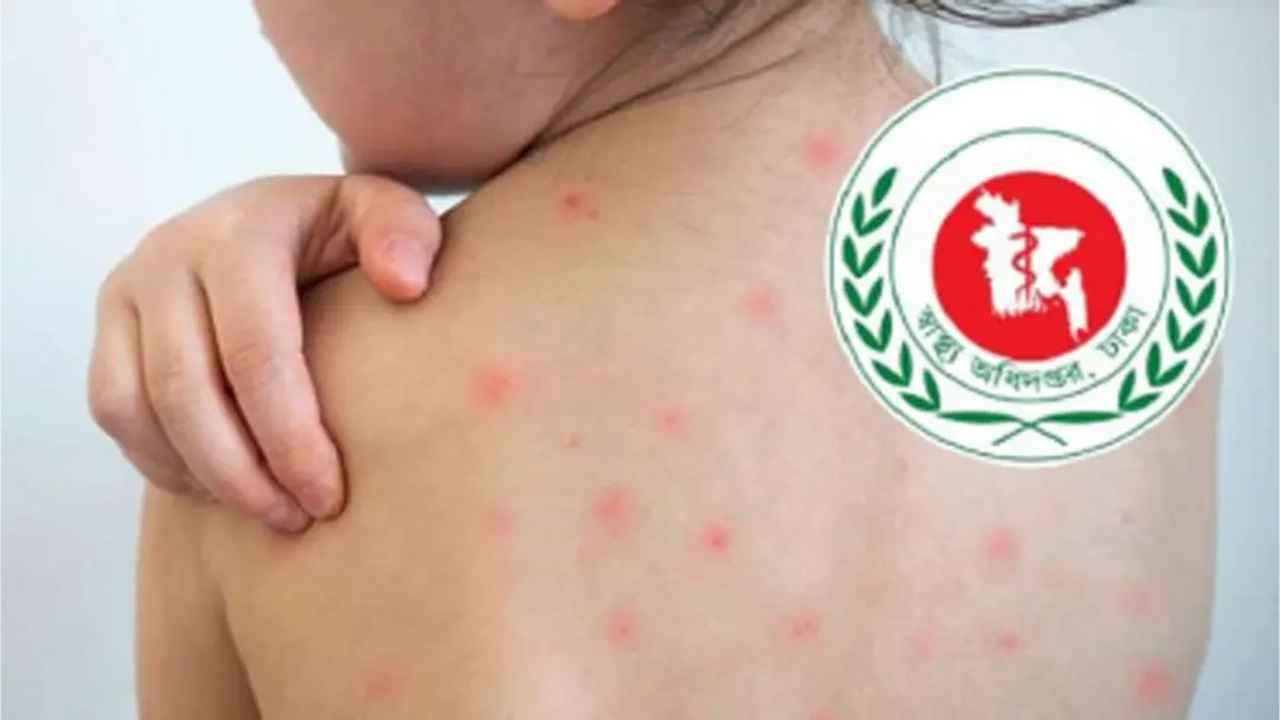 হামের উপসর্গ নিয়ে আরও ৪ শিশুর মৃত্যু