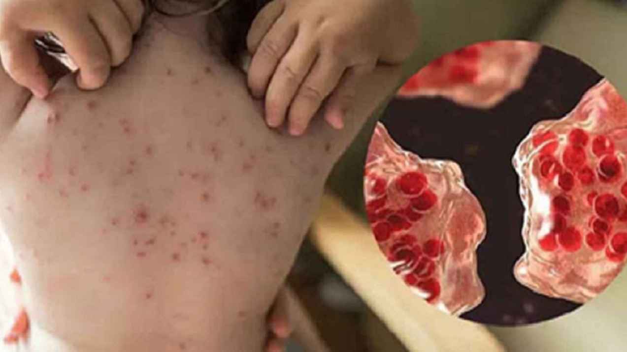 হাম ও উপসর্গে আরও ৬ শিশুর মৃত্যু
