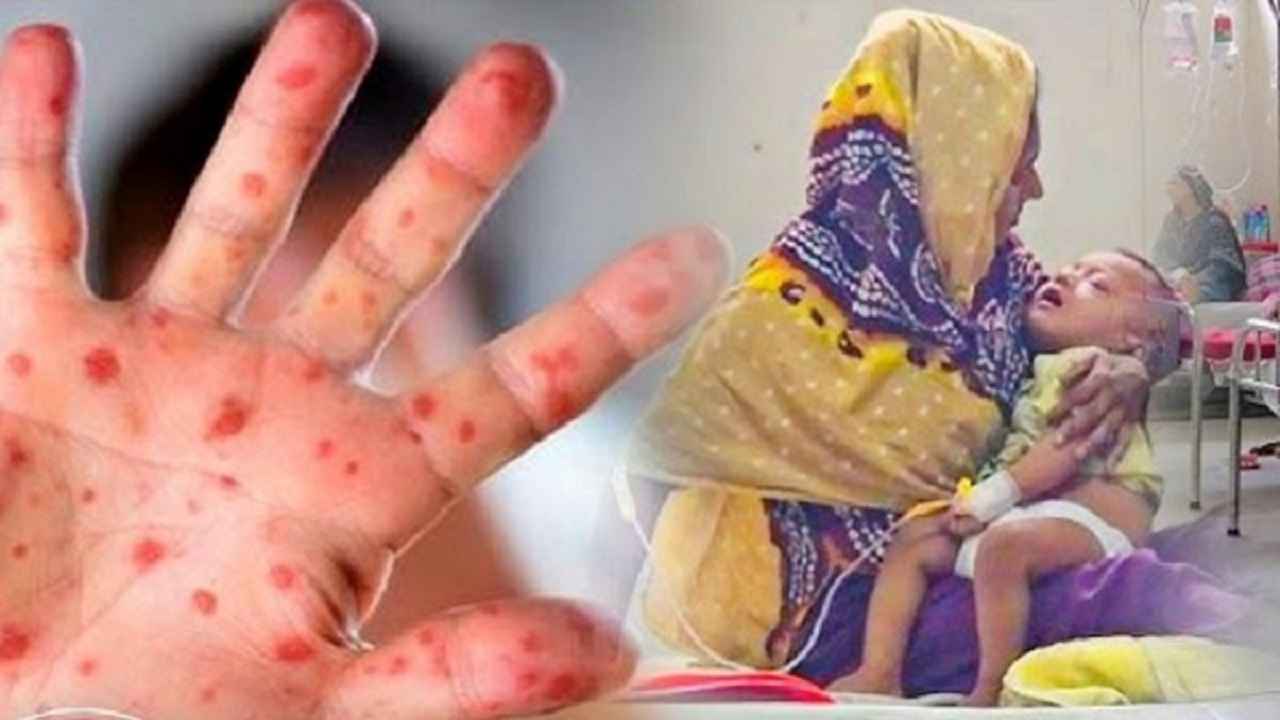 ২৪ ঘণ্টায় হাম ও উপসর্গে আরও ৭ শিশুর মৃত্যু