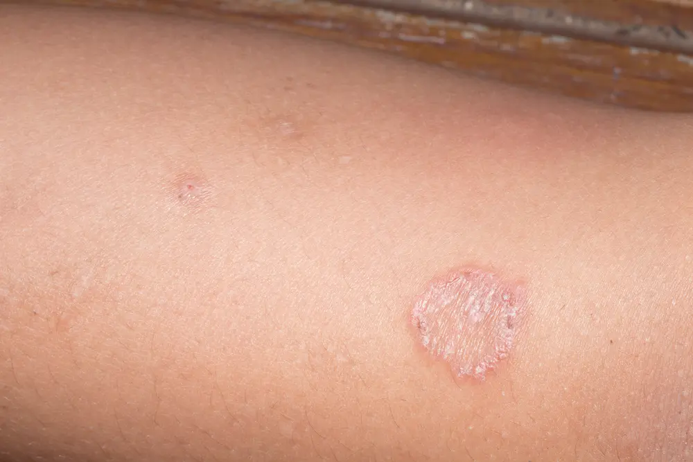 ringworm