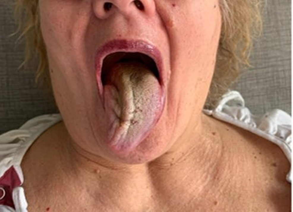 stroke_4