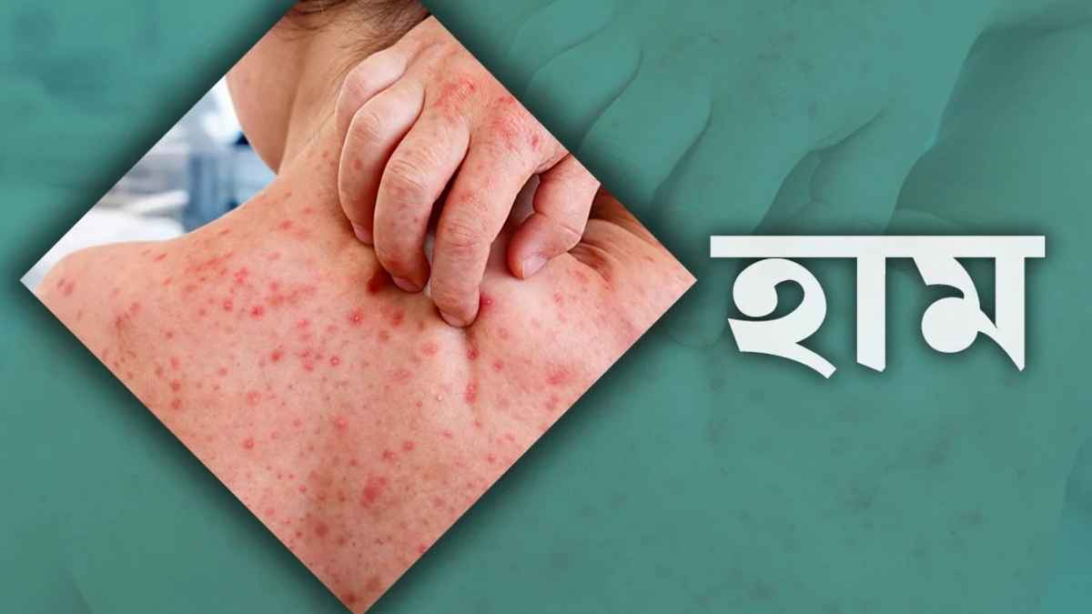 হামের উপসর্গে সিলেটে আরও দুই শিশুর মৃত্যু